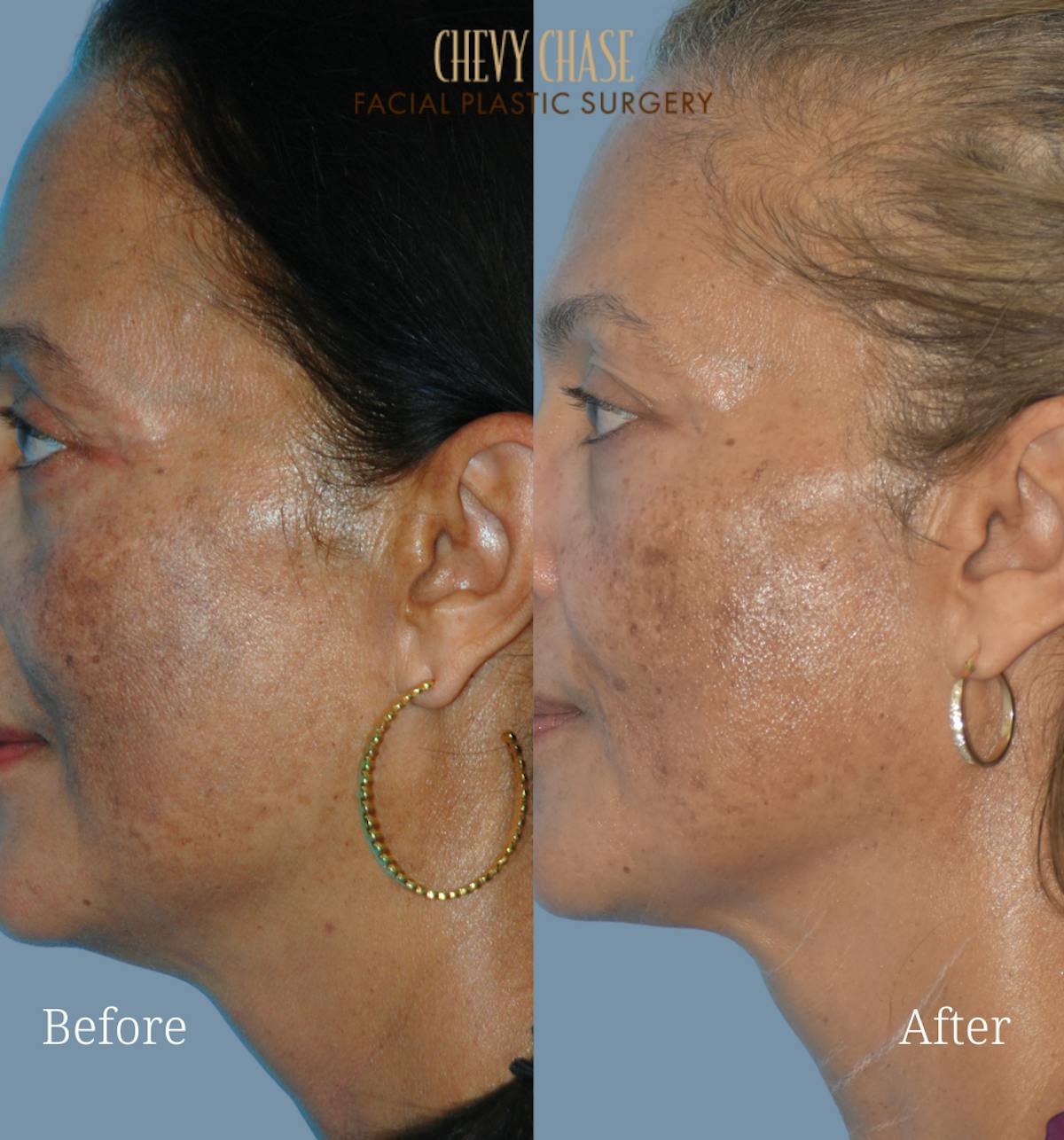 Aerolase Neo® Before & After Gallery - Patient 200814 - Image 4