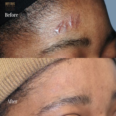 Combination Treatments Before & After Gallery - Patient 157523 - Image 1
