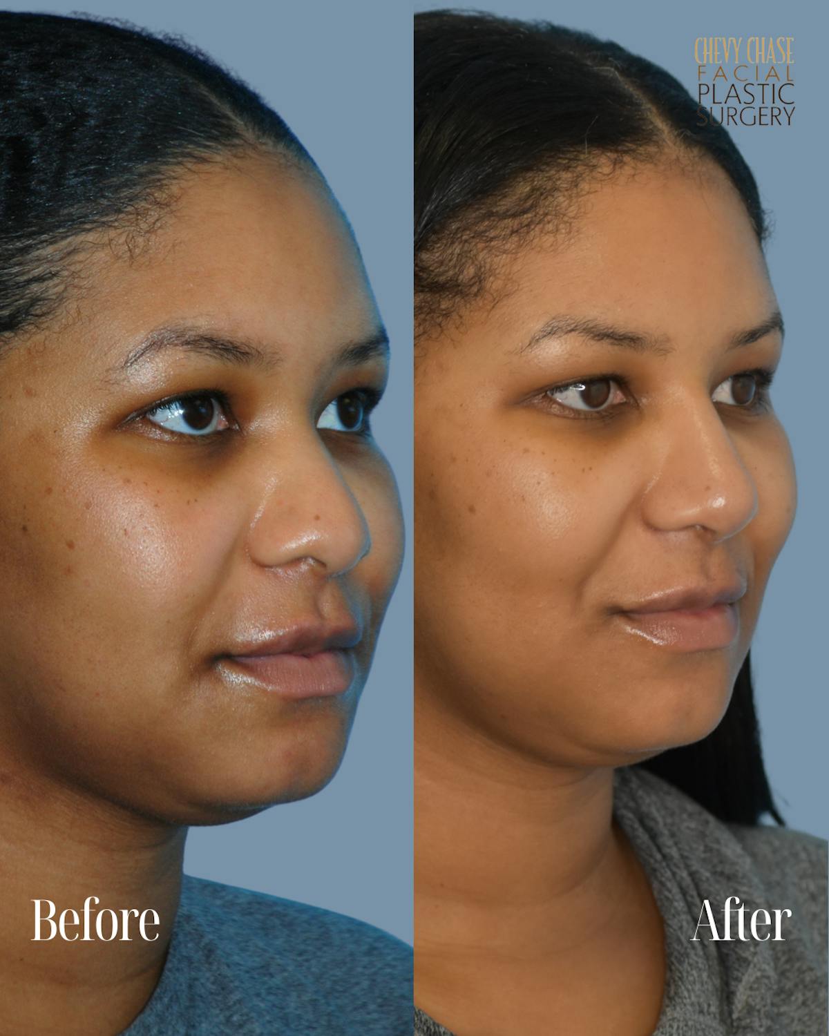 Rhinoplasty Before & After Gallery - Patient 238725 - Image 3