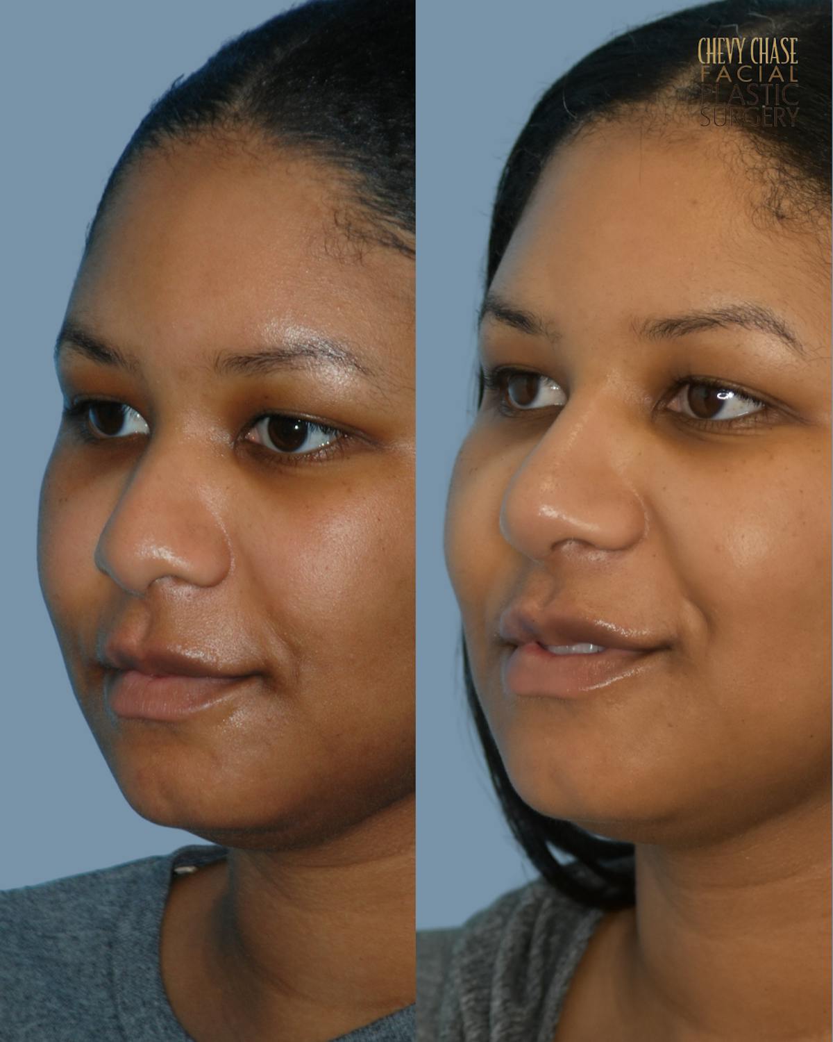 Rhinoplasty Before & After Gallery - Patient 238725 - Image 2