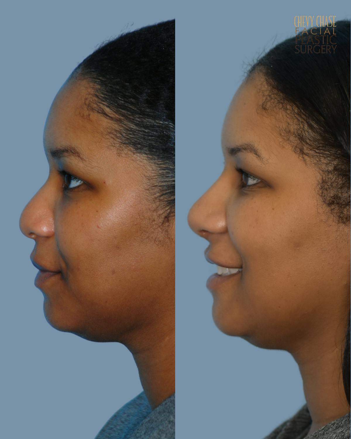 Rhinoplasty Before & After Gallery - Patient 238725 - Image 1