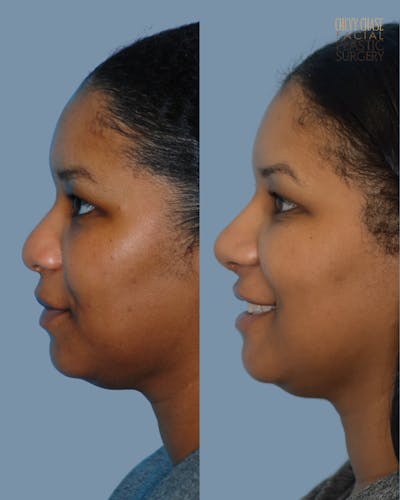 Rhinoplasty Before & After Gallery - Patient 238725 - Image 1