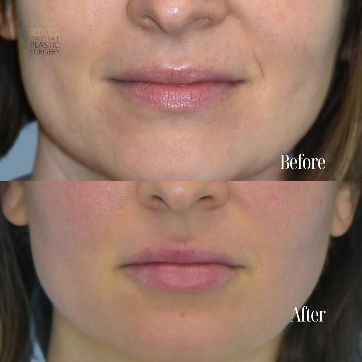 Dermal Fillers Before & After Gallery - Patient 229907 - Image 1