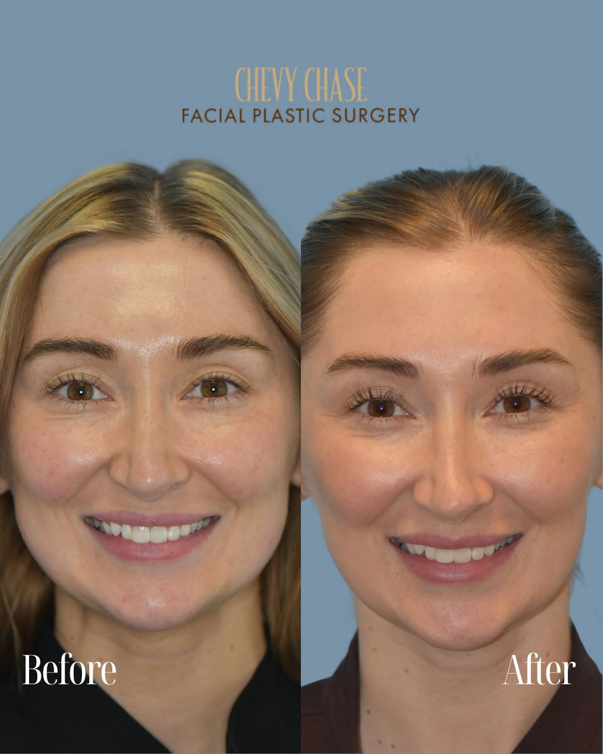 Botox® / Wrinkle Treatments Before & After Gallery - Patient 330268 - Image 1