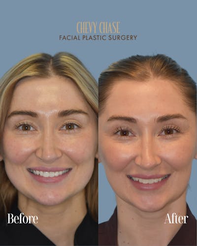Botox® / Wrinkle Treatments Before & After Gallery - Patient 330268 - Image 1
