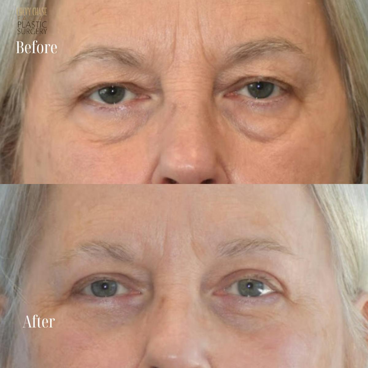 Blepharoplasty Before & After Gallery - Patient 842271 - Image 1