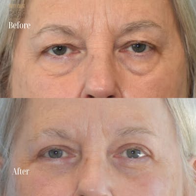 Blepharoplasty Before & After Gallery - Patient 842271 - Image 1
