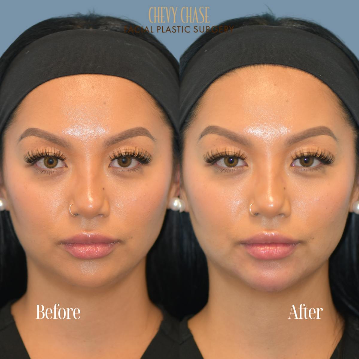 Dermal Fillers Before & After Gallery - Patient 119163 - Image 1