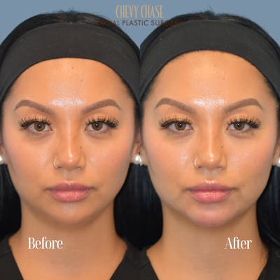 Dermal Fillers Before & After Gallery - Patient 119163 - Image 1