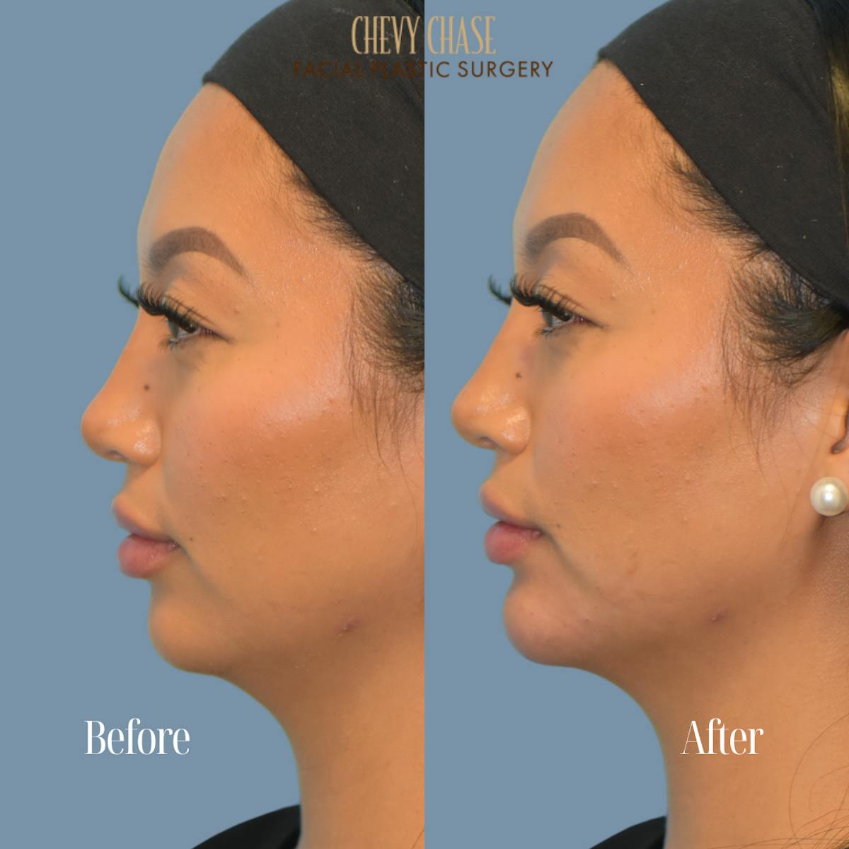 Dermal Fillers Before & After Gallery - Patient 119163 - Image 2