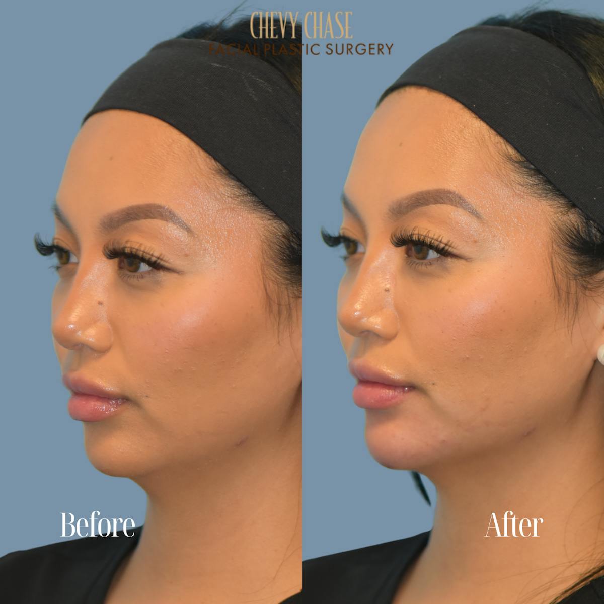 Dermal Fillers Before & After Gallery - Patient 119163 - Image 3