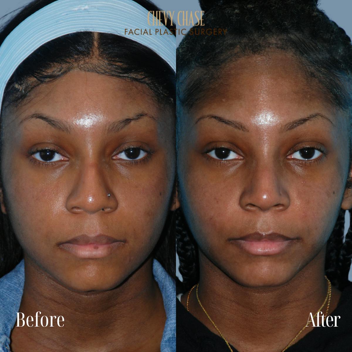 Rhinoplasty Before & After Gallery - Patient 932882 - Image 3