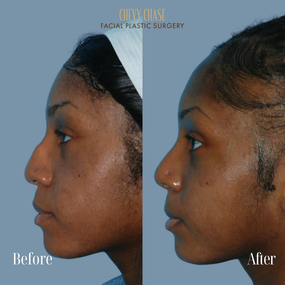 Rhinoplasty Before & After Gallery - Patient 932882 - Image 1