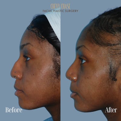 Rhinoplasty Before & After Gallery - Patient 932882 - Image 1