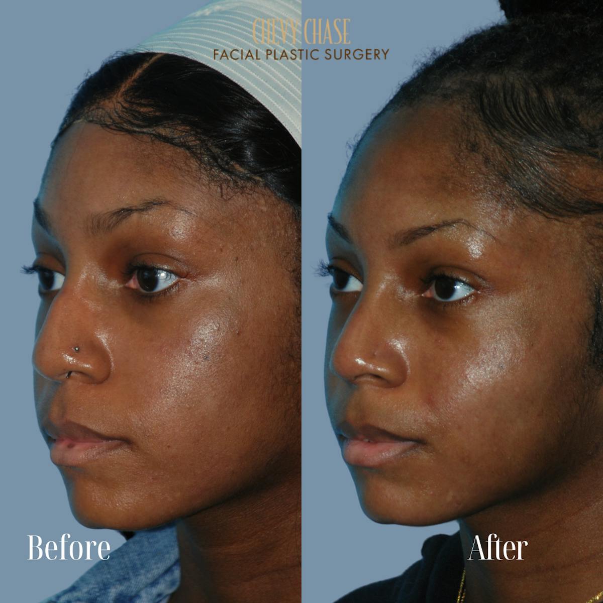 Rhinoplasty Before & After Gallery - Patient 932882 - Image 2