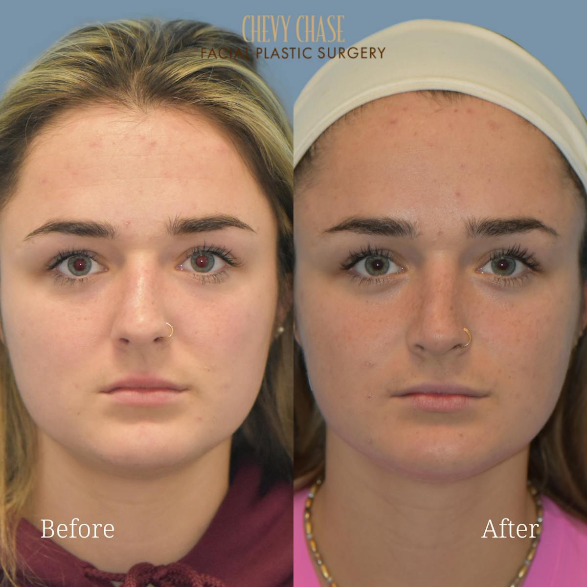 Rhinoplasty Before & After Gallery - Patient 147656 - Image 3