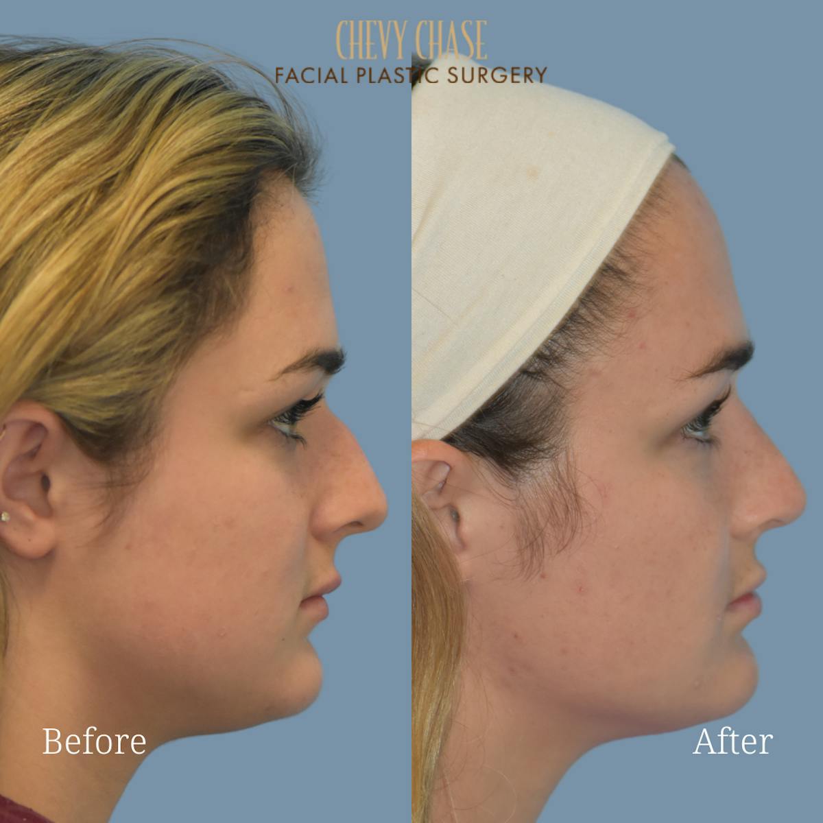 Rhinoplasty Before & After Gallery - Patient 147656 - Image 5