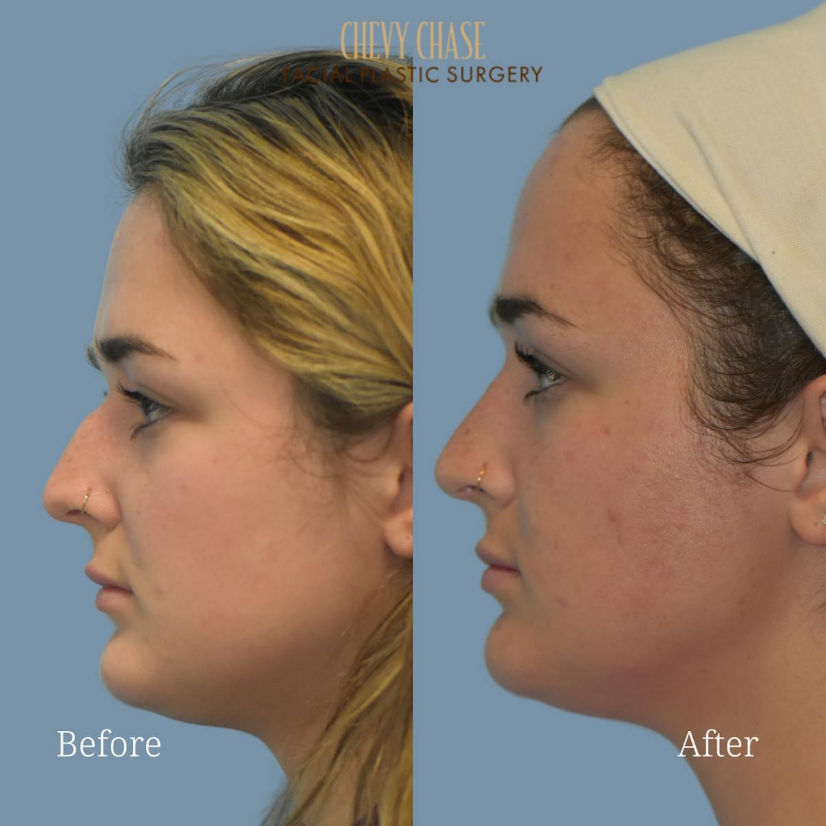 Rhinoplasty Before & After Gallery - Patient 147656 - Image 1
