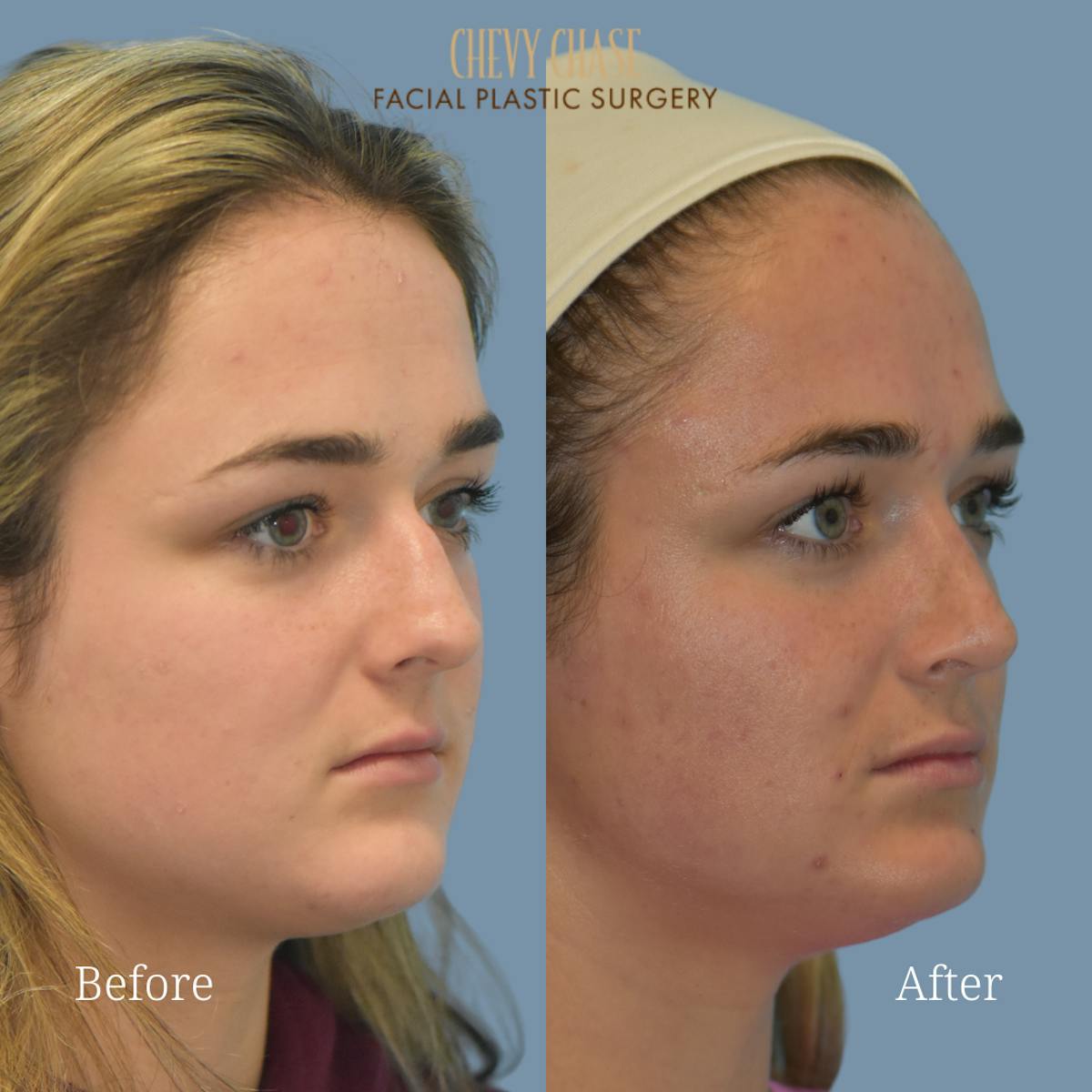 Rhinoplasty Before & After Gallery - Patient 147656 - Image 4