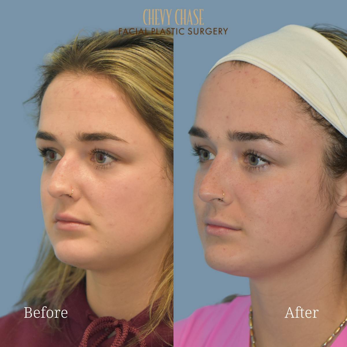 Rhinoplasty Before & After Gallery - Patient 147656 - Image 2