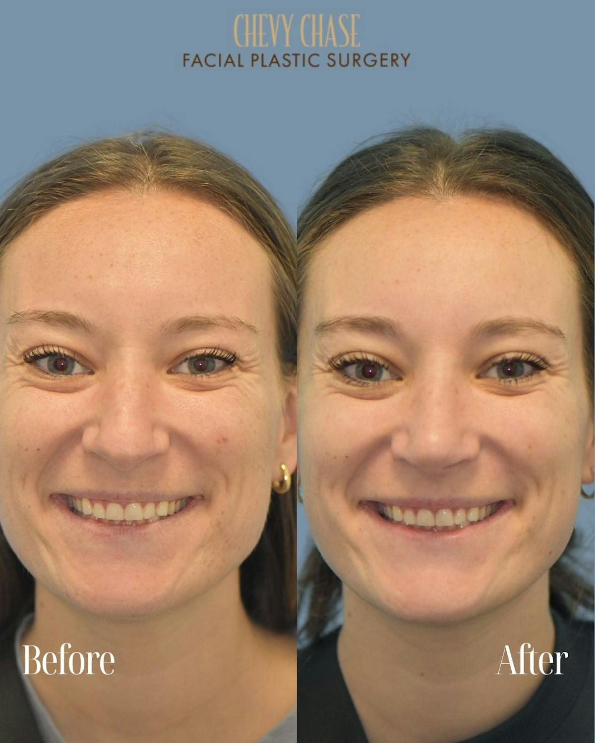 Rhinoplasty Before & After Gallery - Patient 604823 - Image 3