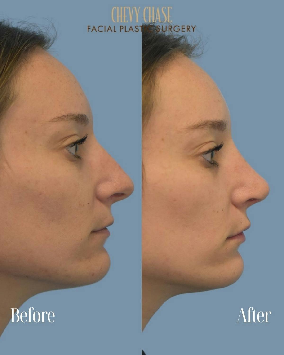 Rhinoplasty Before & After Gallery - Patient 604823 - Image 5