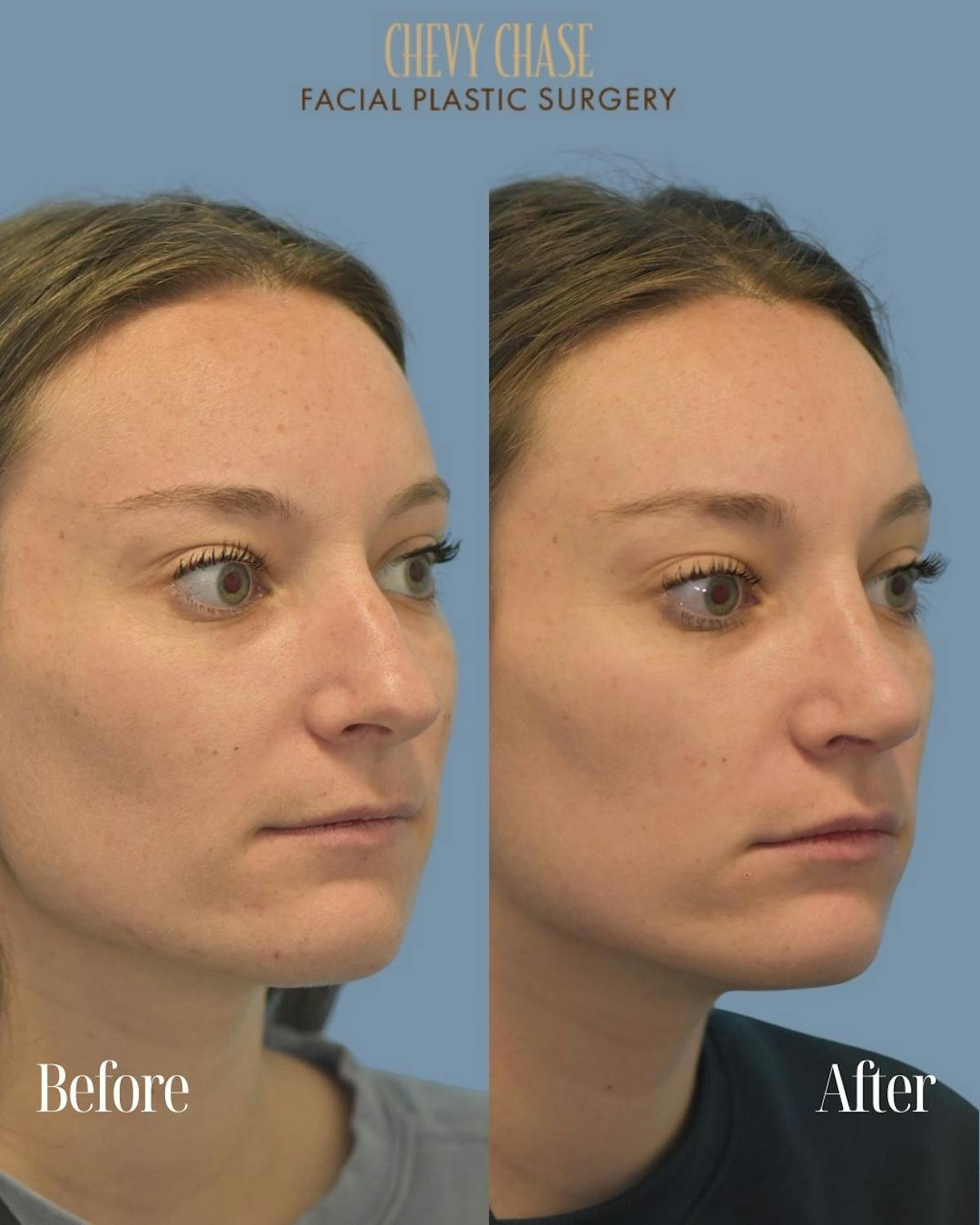 Rhinoplasty Before & After Gallery - Patient 604823 - Image 4