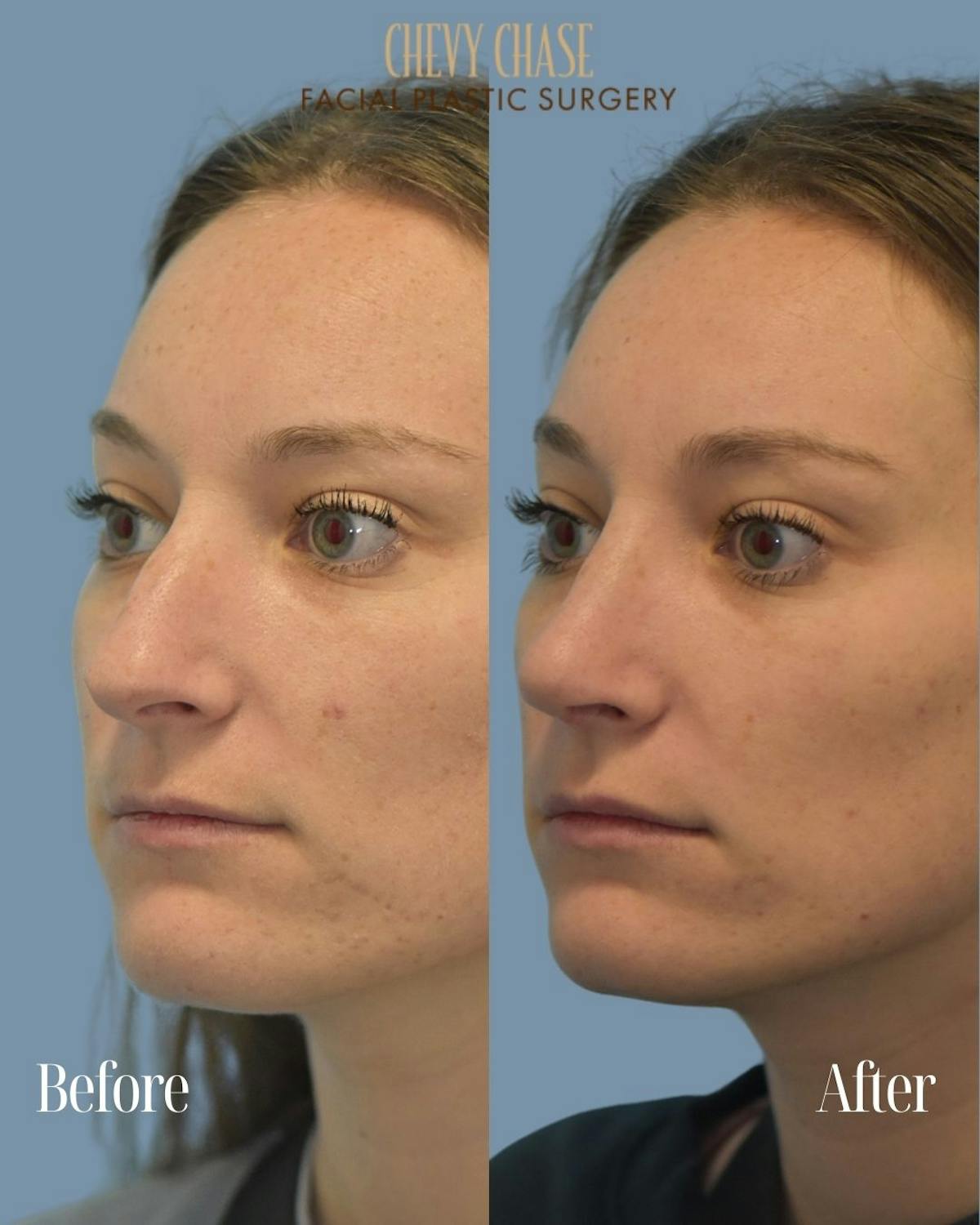 Rhinoplasty Before & After Gallery - Patient 604823 - Image 2