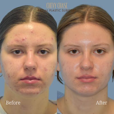 Aerolase Neo® Before & After Gallery - Patient 953402 - Image 1
