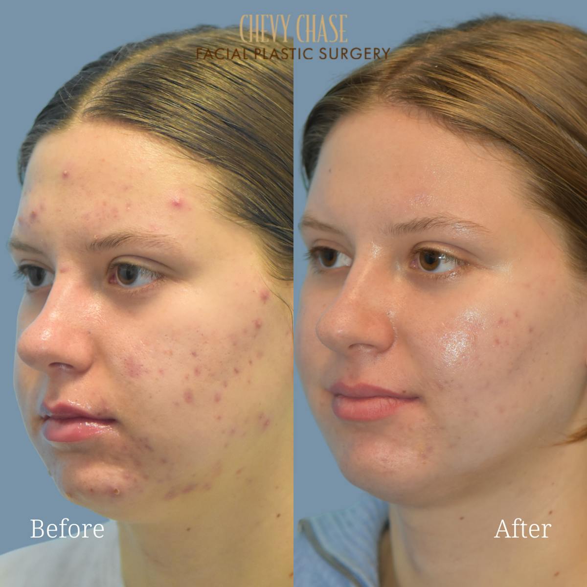 Aerolase Neo® Before & After Gallery - Patient 953402 - Image 2
