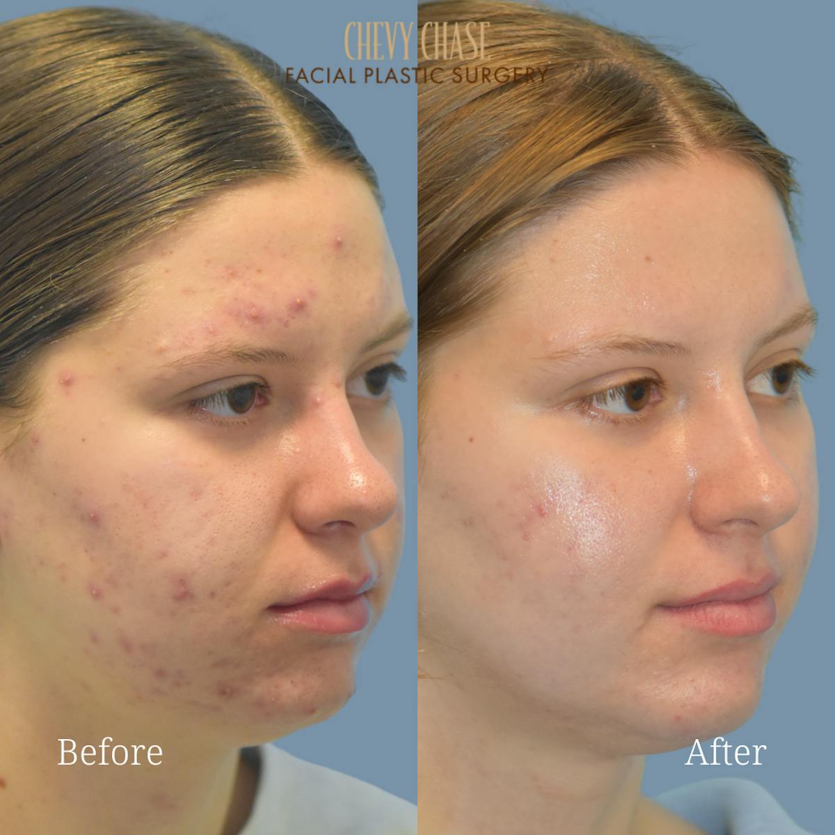 Aerolase Neo® Before & After Gallery - Patient 953402 - Image 3