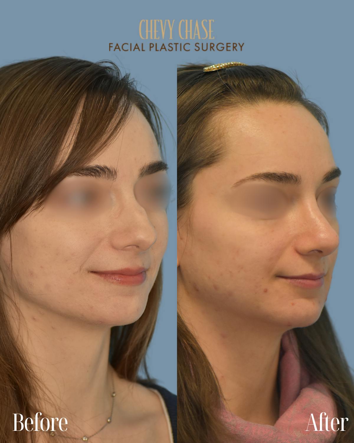 Rhinoplasty Before & After Gallery - Patient 990295 - Image 4