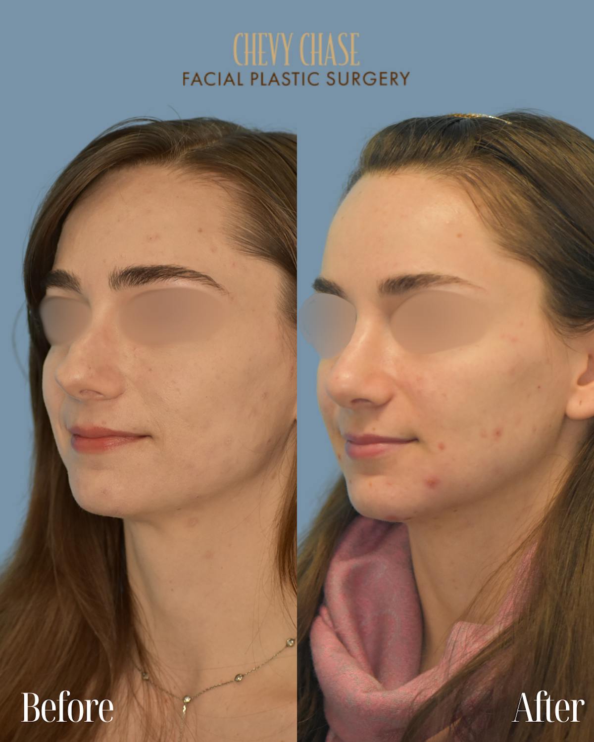 Rhinoplasty Before & After Gallery - Patient 990295 - Image 2