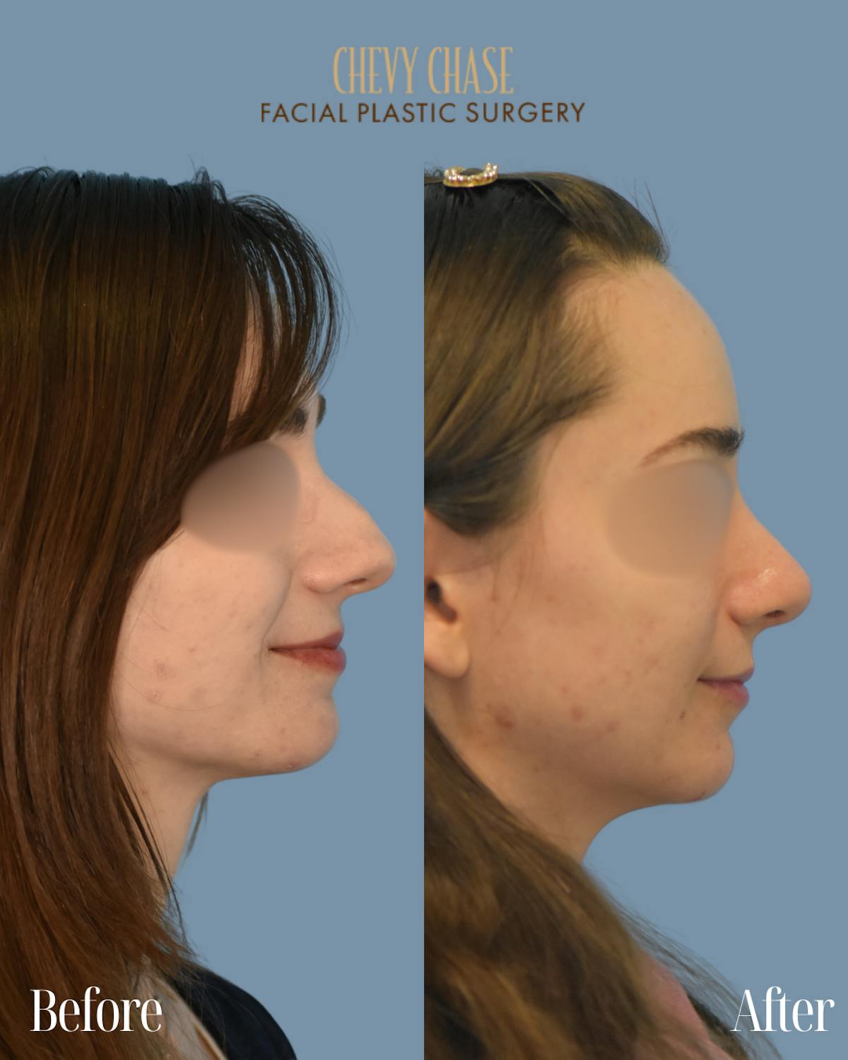 Rhinoplasty Before & After Gallery - Patient 990295 - Image 5