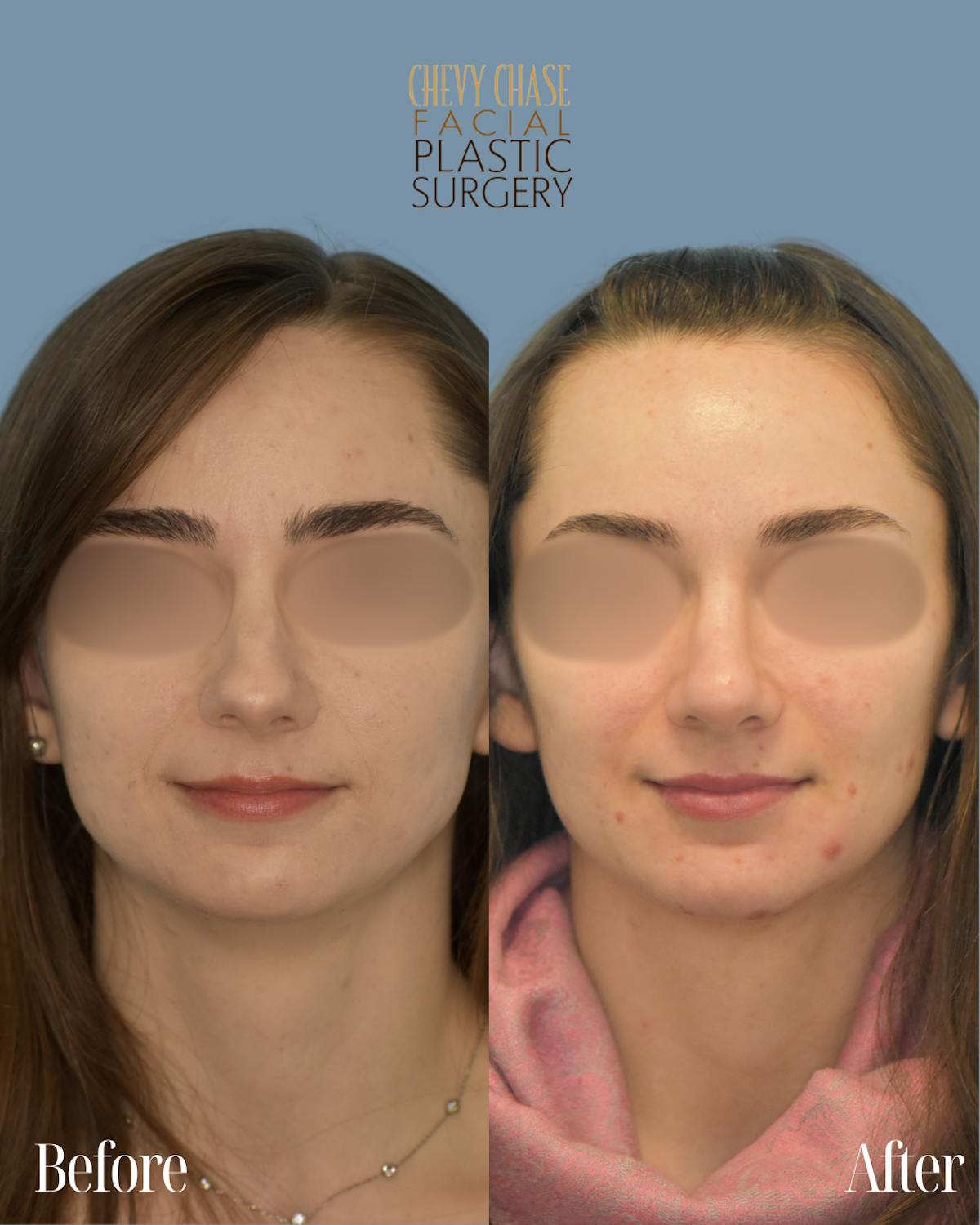 Rhinoplasty Before & After Gallery - Patient 990295 - Image 3