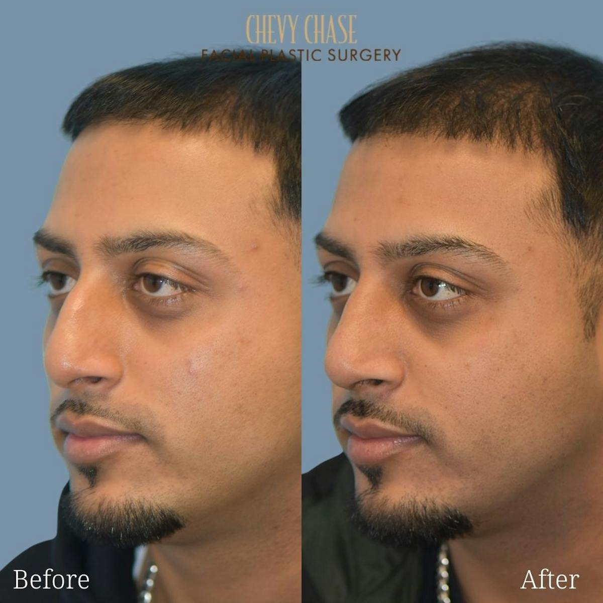 Rhinoplasty Before & After Gallery - Patient 247532 - Image 2