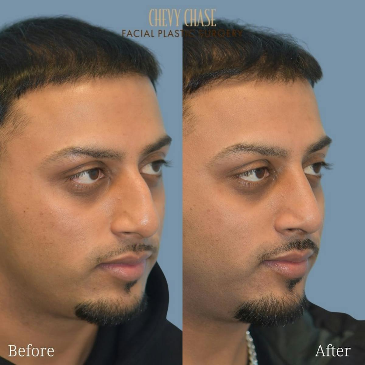 Rhinoplasty Before & After Gallery - Patient 247532 - Image 4