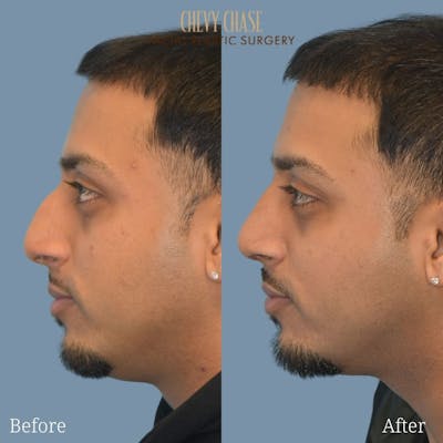 Rhinoplasty Before & After Gallery - Patient 247532 - Image 1