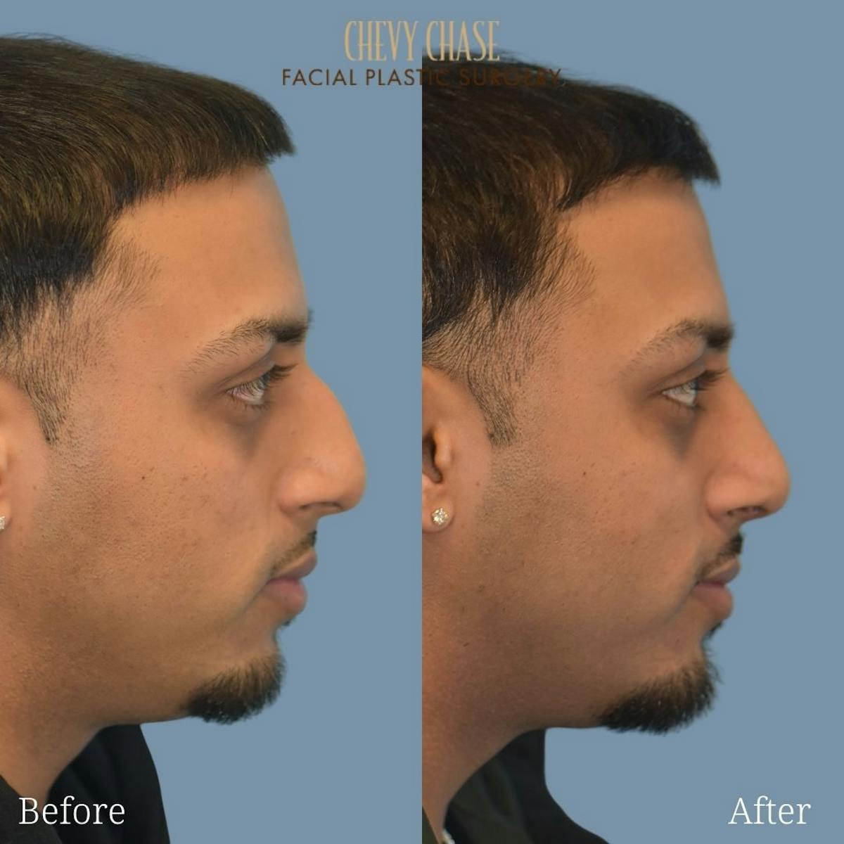 Rhinoplasty Before & After Gallery - Patient 247532 - Image 5