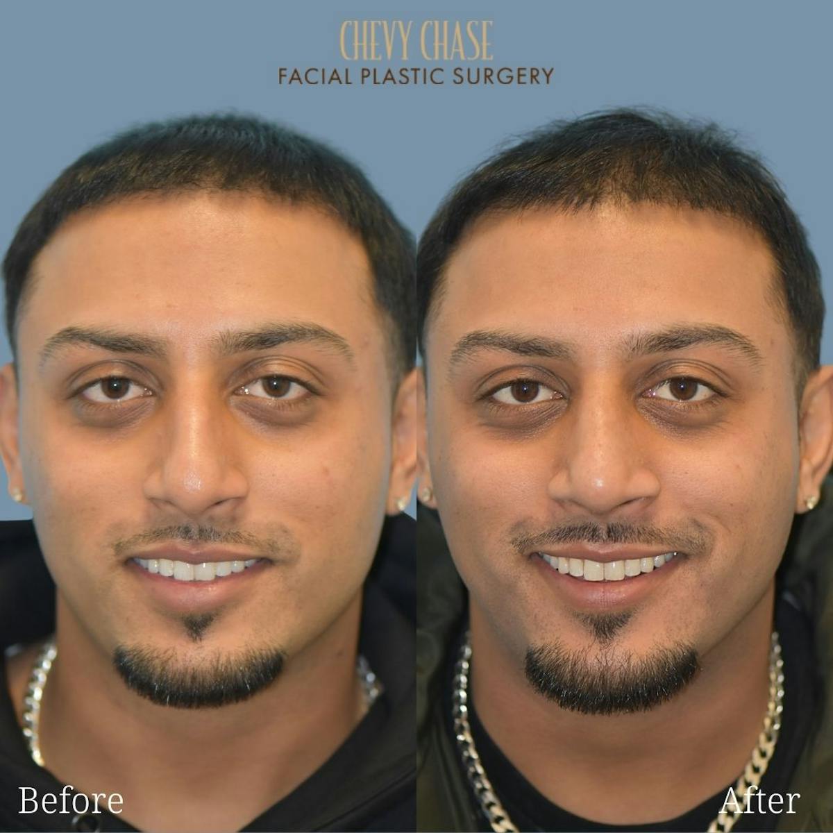 Rhinoplasty Before & After Gallery - Patient 247532 - Image 3