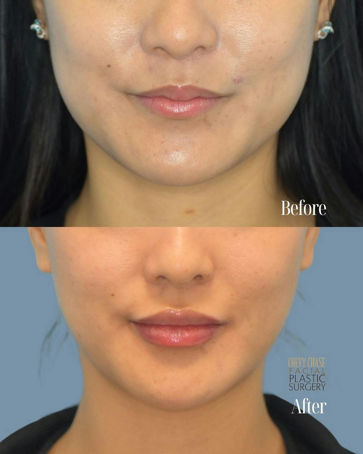Dermal Fillers Before & After Gallery - Patient 163611 - Image 1
