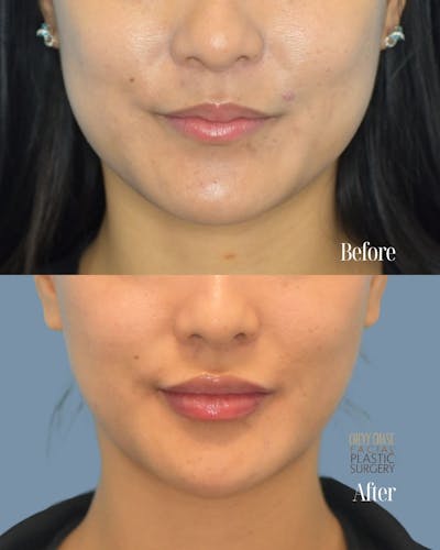 Dermal Fillers Before & After Gallery - Patient 163611 - Image 1