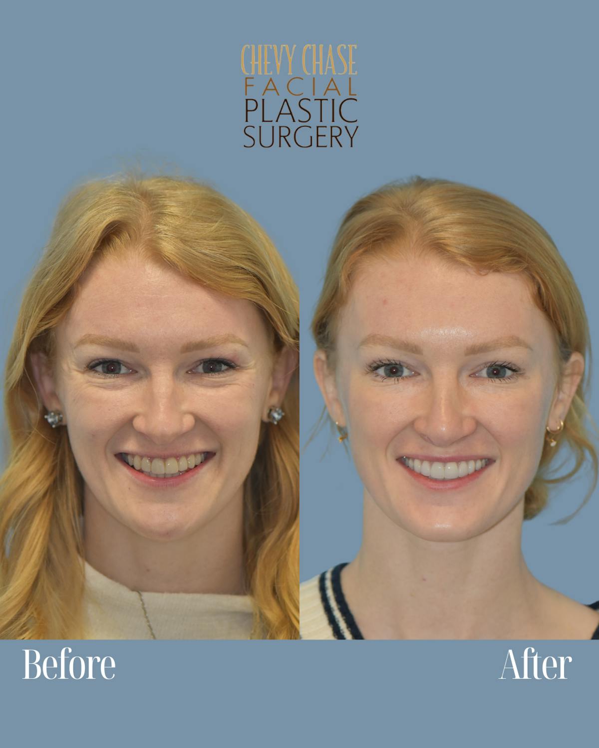 Botox® / Wrinkle Treatments Before & After Gallery - Patient 362417 - Image 1