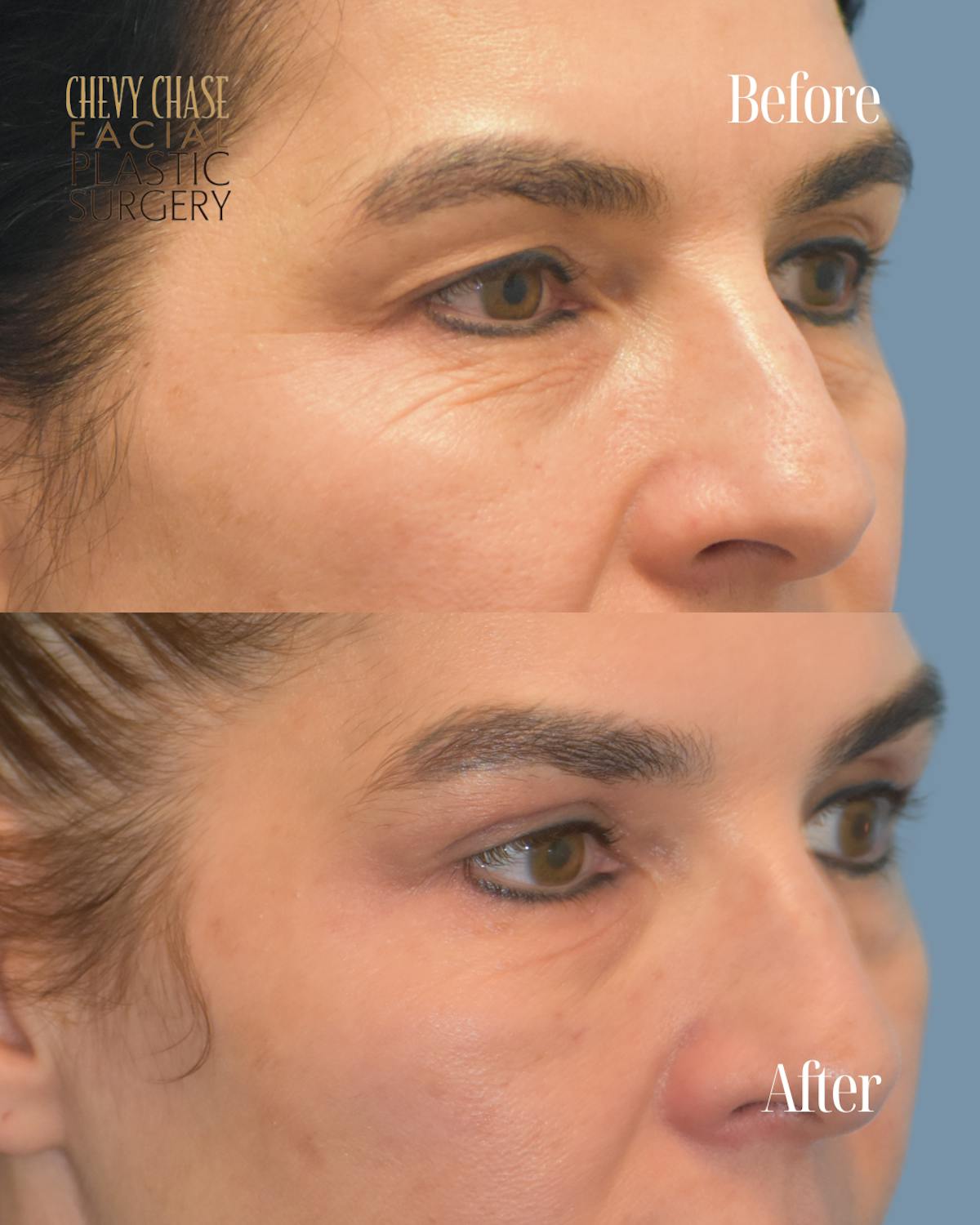 Blepharoplasty Before & After Gallery - Patient 160195 - Image 2