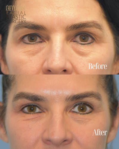 Blepharoplasty Before & After Gallery - Patient 160195 - Image 1