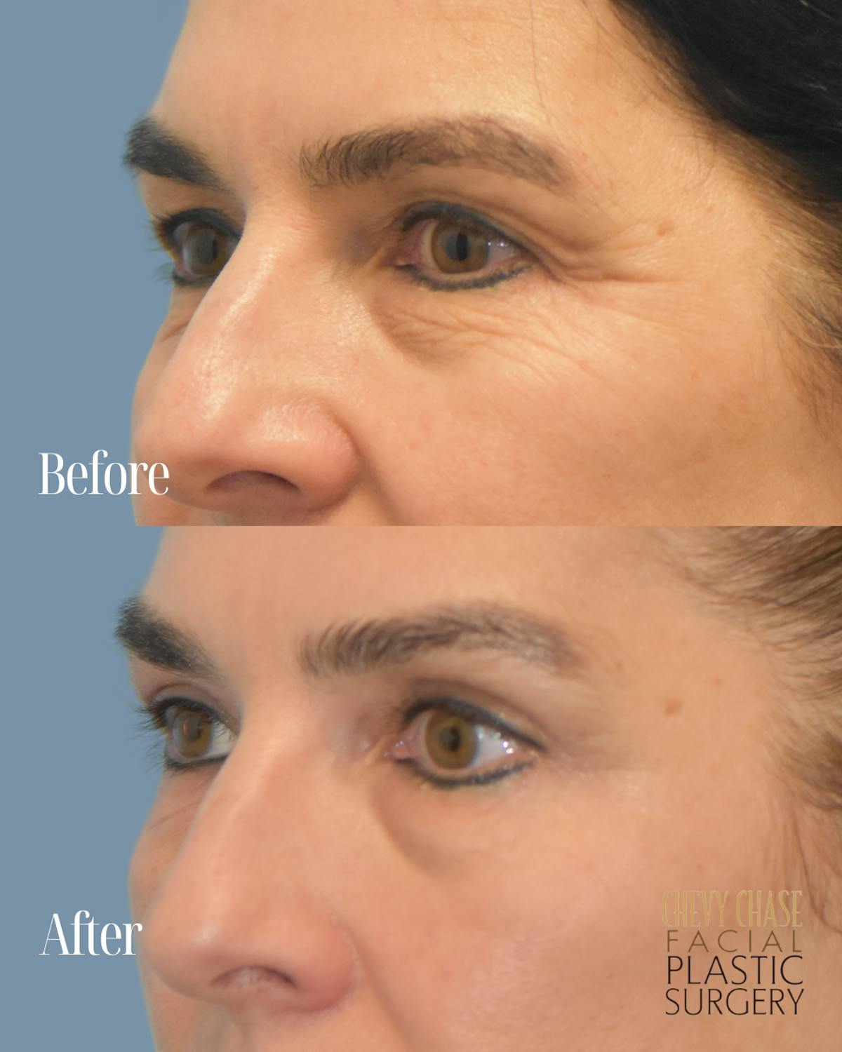 Blepharoplasty Before & After Gallery - Patient 160195 - Image 4