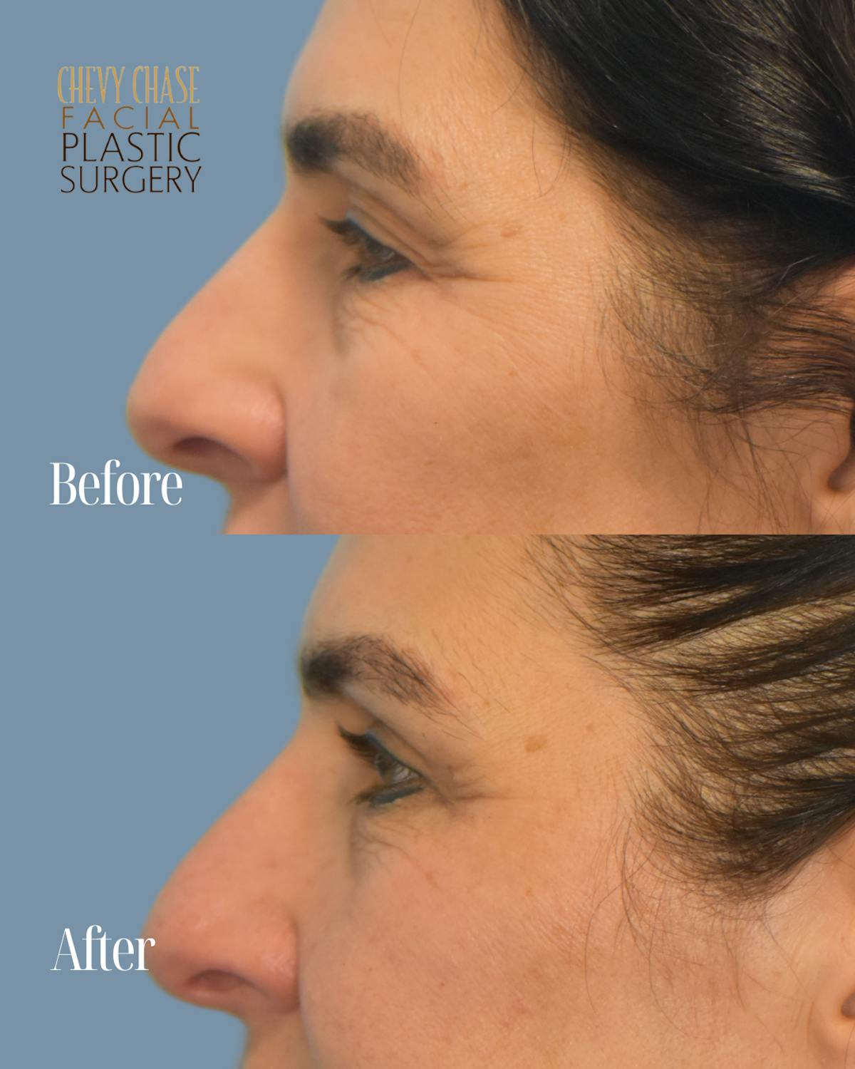 Blepharoplasty Before & After Gallery - Patient 160195 - Image 5