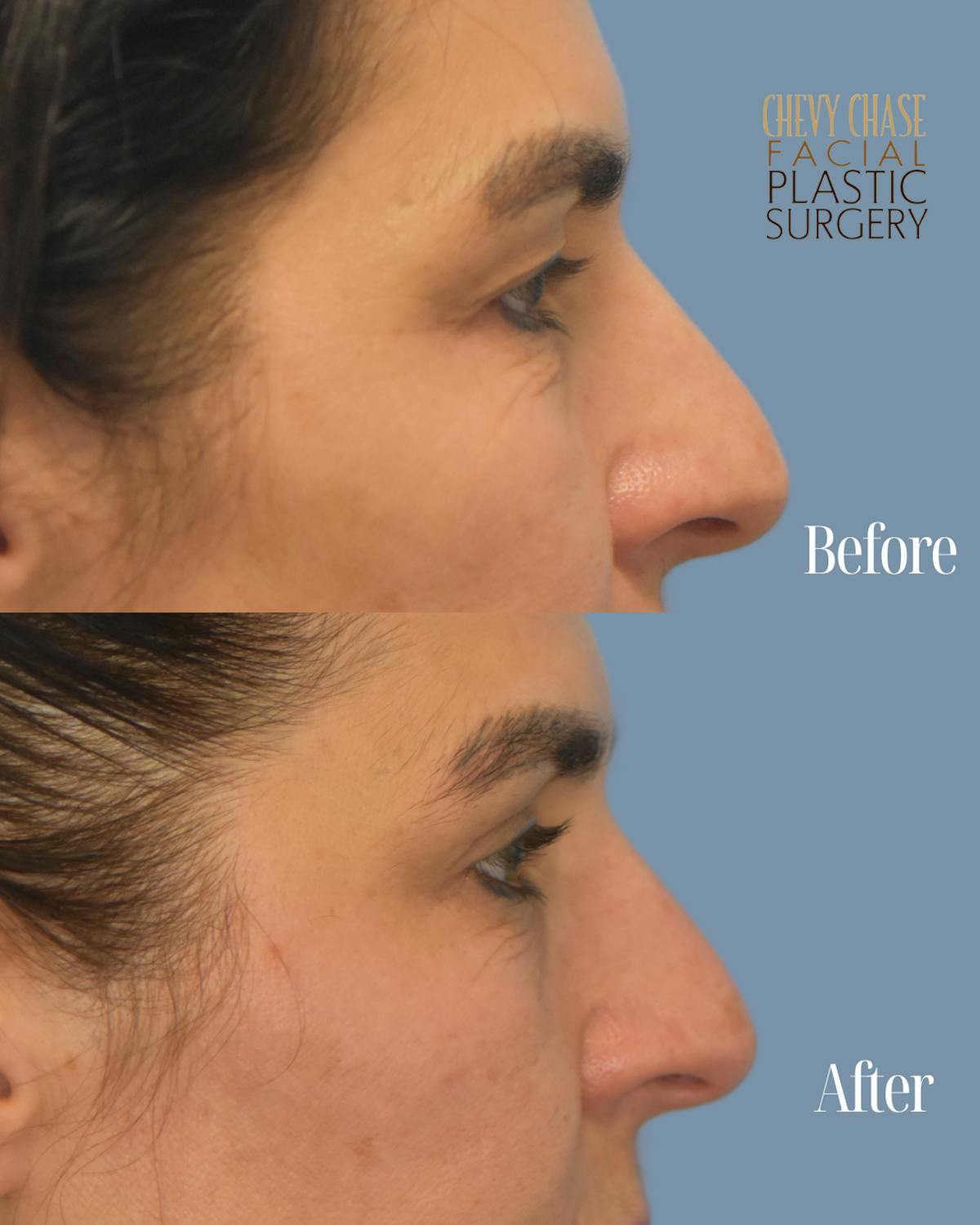 Blepharoplasty Before & After Gallery - Patient 160195 - Image 3