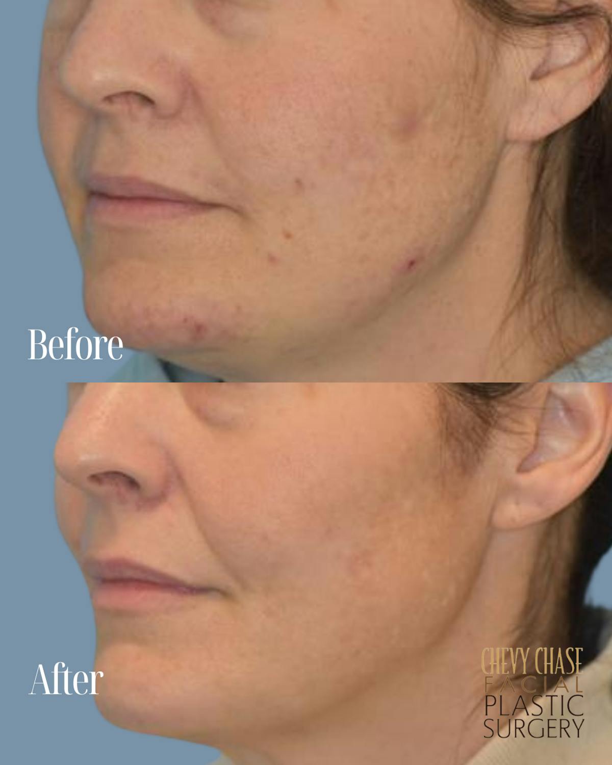 Broadband Light (BBL) Before & After Gallery - Patient 627115 - Image 4