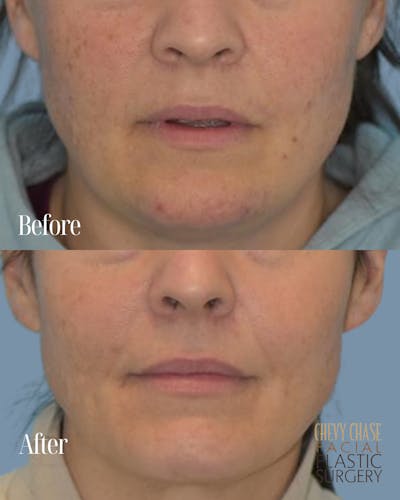 Broadband Light (BBL) Before & After Gallery - Patient 627115 - Image 1